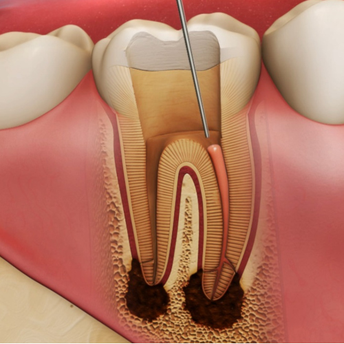 endodontia