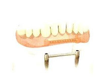 sobredentadura por barra