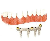 sobredentadura por barra