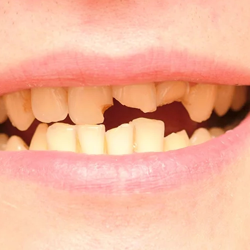 Traumatismos dentários